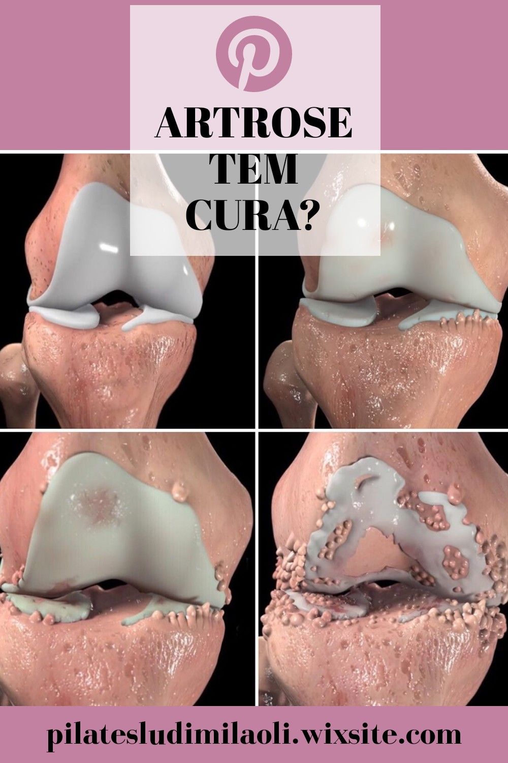 Artrose tem cura?