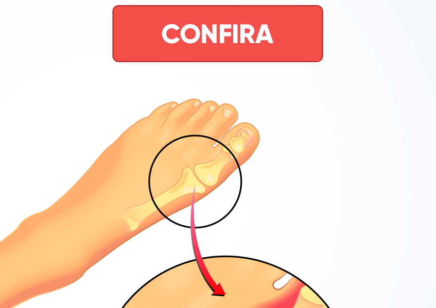 Dor constante nas costas pode ser ácido úrico elevado