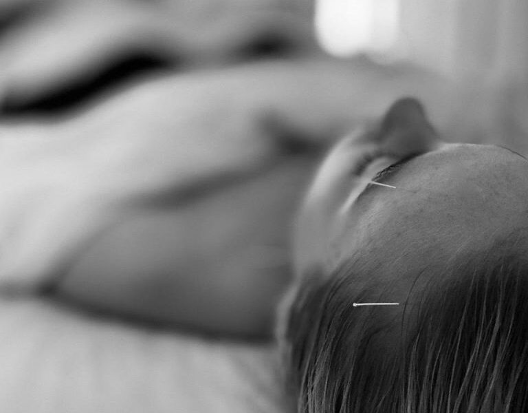 I Tried Cosmetic Acupuncture (AKA Natural Botox)—Here’s My Take