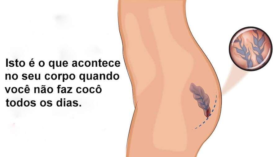 Isto é o que acontece no seu corpo quando você não faz cocô todos os dias