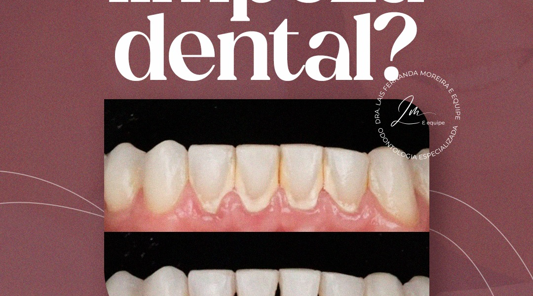 Quando foi a sua última limpeza denta?